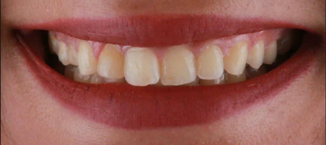 Lamine-Veneer-once