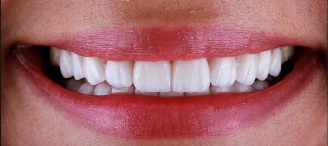 Lamine-Veneer-sonra